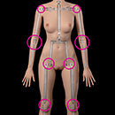 Limb Weakness Joint Tightness